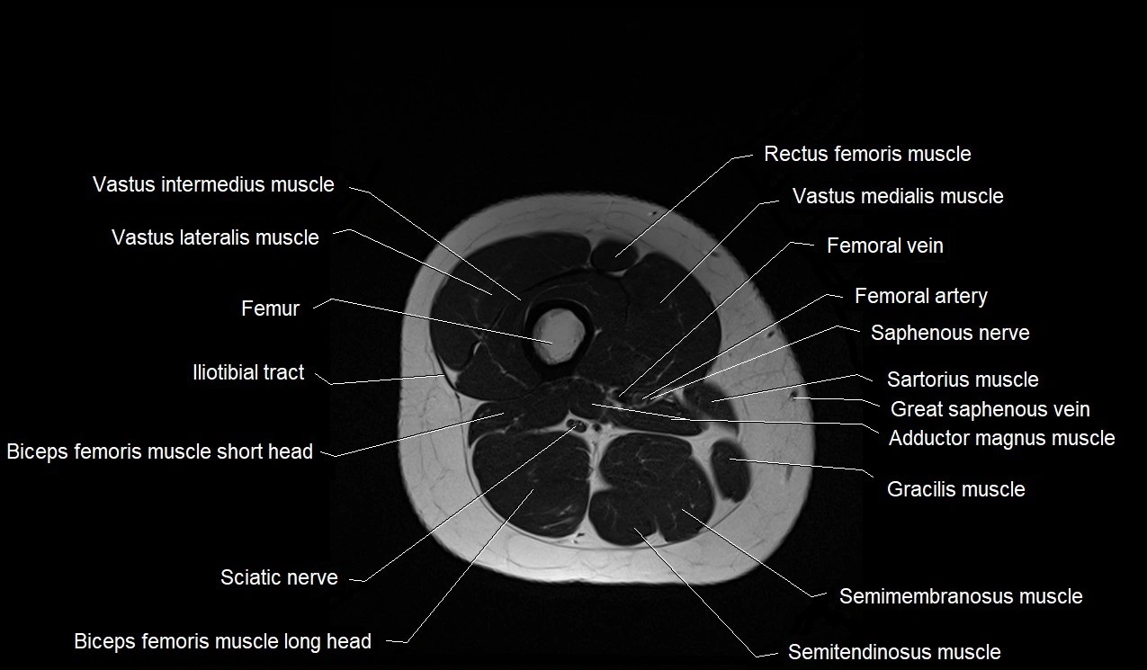 MRI thigh cross sectional anatomy image 40.webp